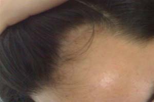 斑秃患者需要注意自己的情绪