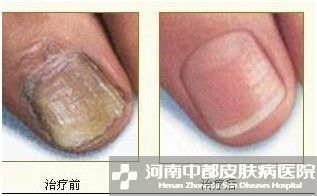 灰指甲症状图片